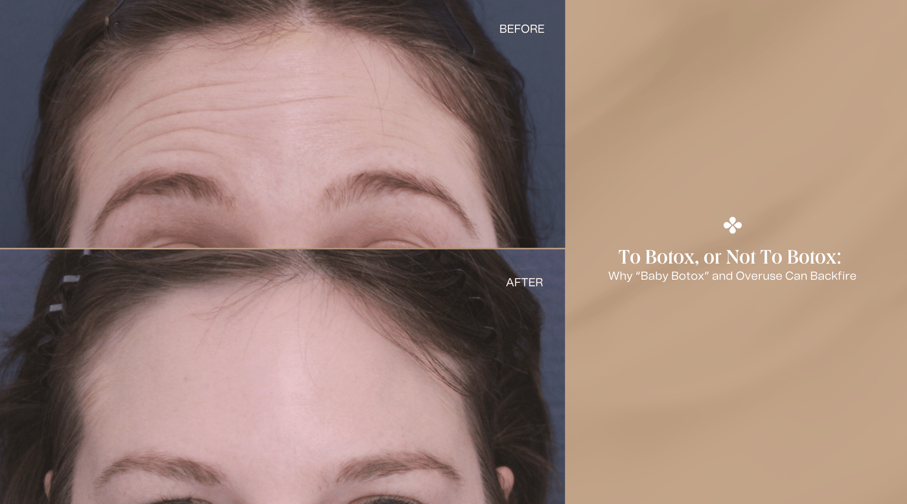 To Botox, or Not to Botox: Why “Baby Botox” and Overuse Can Backfire